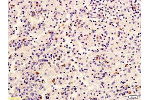 Formalin-fixed and paraffin embedded human cervical carcinoma labeled with Anti-HER2/NEU/ErbB2 Polyclonal Antibody, Unconjugated  at 1:400 followed by conjugation to the secondary antibody and DAB staining (ErbB2/Her2 Antikörper  (AA 1210-1255))