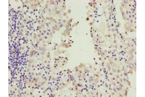 Immunohistochemistry of paraffin-embedded human lung cancer using ABIN7167244 at dilution of 1:100