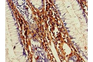 Immunohistochemistry of paraffin-embedded human colon cancer using ABIN7148281 at dilution of 1:100