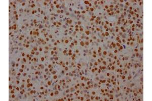 IHC image of ABIN7127805 diluted at 1:100 and staining in paraffin-embedded human glioma cancer performed on a Leica BondTM system. (Rekombinanter SF3B1 Antikörper)