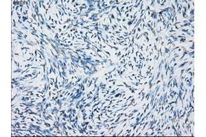 Immunohistochemical staining of paraffin-embedded Adenocarcinoma of breast tissue using anti-NAT8 mouse monoclonal antibody. (NAT8 Antikörper)