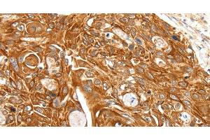 Immunohistochemistry of paraffin-embedded Human esophagus cancer using SFTPA1 Polyclonal Antibody at dilution of 1:30 (Surfactant Protein A1 Antikörper)
