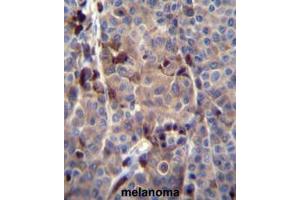 PRAMEF8 Antibody (C-term) immunohistochemistry analysis in formalin fixed and paraffin embedded human melanoma tissue followed by peroxidase conjugation of the secondary antibody and DAB staining.