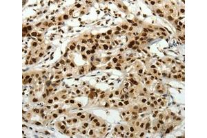 Immunohistochemical analysis of paraffin-embedded Human lung cancer tissue using at dilution 1/40. (SCN11A Antikörper  (Internal Region))
