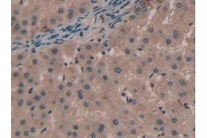 Detection of TNPO1 in Human Liver cancer Tissue using Polyclonal Antibody to Transportin 1 (TNPO1) (Transportin 1 Antikörper  (AA 626-836))