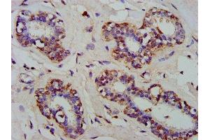 IHC image of ABIN7143526 diluted at 1:300 and staining in paraffin-embedded human breast cancer performed on a Leica BondTM system. (ARFRP1 Antikörper  (AA 1-201))