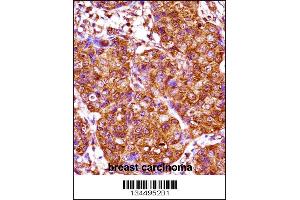 IRX3 Antibody immunohistochemistry analysis in formalin fixed and paraffin embedded human breast carcinoma followed by peroxidase conjugation of the secondary antibody and DAB staining. (IRX3 Antikörper  (N-Term))