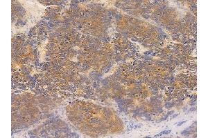 ABIN6259932 and ABIN6277014 at 1/100 staining human small cell lung carcinoma by IHC-P.