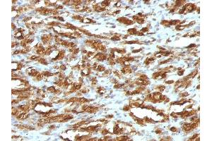 Formalin-fixed, paraffin-embedded human Rhabdomyosarcoma stained with Muscle Specific Actin Mouse Monoclonal Antibody (HHF35). (ACTA1/ACTA2A/ACTG2 Antikörper)