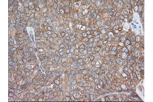 Immunohistochemical staining of paraffin-embedded Adenocarcinoma of Human colon tissue using anti-PDE4A mouse monoclonal antibody. (PDE4A Antikörper)