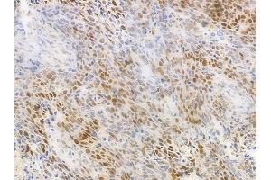 ABIN6263144 and ABIN6277139 at 1/100 staining human large cell lung carcinoma by IHC-P. (MAX Antikörper  (N-Term))