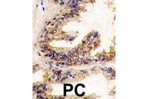 Formalin-fixed and paraffin-embedded human prostate carcinoma reacted with BRAF polyclonal antibody  , which was peroxidase-conjugated to the secondary antibody, followed by DAB staining. (BRAF Antikörper  (Internal Region))