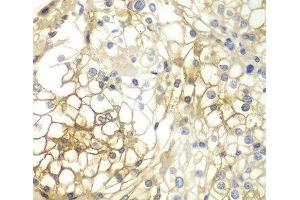 Immunohistochemistry of paraffin-embedded Human kidney cancer using Syndecan-1 Polyclonal Antibody at dilution of 1:200 (40x lens). (Syndecan 1 Antikörper)
