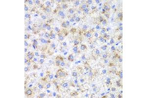 Immunohistochemistry of paraffin-embedded human liver cancer using HAO1 antibody. (HAO1 Antikörper)