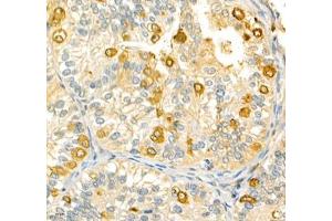 Immunohistochemistry of paraffin embedded human metrocarcinoma using ANXA3 (ABIN7073065) at dilution of 1: 200 (400x lens) (Annexin A3 Antikörper)