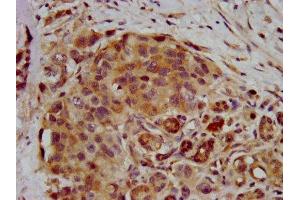 IHC image of ABIN7168260 diluted at 1:400 and staining in paraffin-embedded human pancreatic cancer performed on a Leica BondTM system.