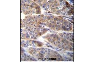 PLA2G2C Antibody (C-term) (ABIN655935 and ABIN2845327) immunohistochemistry analysis in formalin fixed and paraffin embedded human melanoma followed by peroxidase conjugation of the secondary antibody and DAB staining. (PLA2G2C Antikörper  (C-Term))
