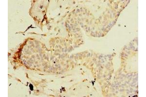 Immunohistochemistry of paraffin-embedded human breast cancer using ABIN7171449 at dilution of 1:100 (TCP11L2 Antikörper  (AA 1-210))