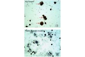 ADORA2A antibody staining of Oral Cell Carcinoma at a dilution of 5 ug/ml (Adenosine A2a Receptor Antikörper  (C-Term))