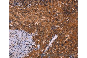 Immunohistochemistry of Human colon cancer using CDC5L Polyclonal Antibody at dilution of 1:40 (CDC5L Antikörper)