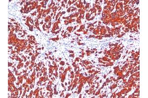 Formalin-fixed, paraffin-embedded human Breast Carcinoma stained with pan Cytokeratin Monoclonal Antibody cocktail (SPM115 + SPM116). (KRT77, KRT76 Antikörper)