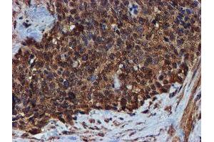 Immunohistochemical staining of paraffin-embedded Adenocarcinoma of Human breast tissue using anti-ENDOG mouse monoclonal antibody. (Endonuclease G Antikörper)