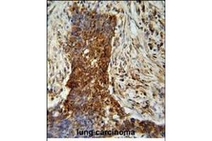 P2 antibody ABIN659015 iunohistochemistry analysis in formalin fixed and paraffin embedded human lung carcinoma followed by peroxidase conjμgation of the secondary antibody and DAB staining. (MMP2 Antikörper)