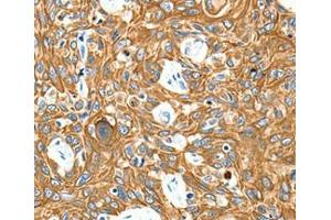 Immunohistochemical analysis of paraffin-embedded Human esophagus cancer tissue using at dilution 1/20. (Adenosine A3 Receptor Antikörper  (Internal Region))