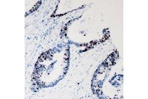 Immunohistochemical analysis of JNK1 staining in human colon cancer formalin fixed paraffin embedded tissue section. (JNK Antikörper)
