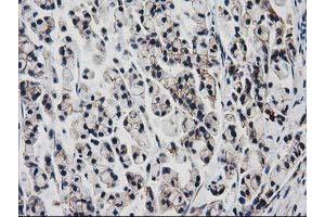 Immunohistochemical staining of paraffin-embedded Adenocarcinoma of Human colon tissue using anti-VCAM1 mouse monoclonal antibody. (VCAM1 Antikörper)