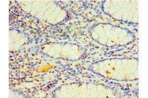 Immunohistochemistry of paraffin-embedded human colon cancer using ABIN7149272 at dilution of 1:100 (CYP4F12 Antikörper  (AA 265-524))