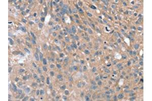 The image on the left is immunohistochemistry of paraffin-embedded Human breast cancer tissue using ABIN7192632(SPON1 Antibody) at dilution 1/25, on the right is treated with synthetic peptide. (SPON1 Antikörper)