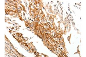 The image on the left is immunohistochemistry of paraffin-embedded Human cervical cancer tissue using ABIN7192777(TGM1 Antibody) at dilution 1/25, on the right is treated with synthetic peptide. (TGM1 Antikörper)