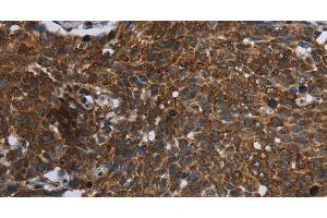Immunohistochemistry of paraffin-embedded Human cervical cancer using FASTKD2 Polyclonal Antibody at dilution of 1:45 (FASTKD2 Antikörper)
