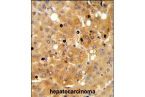 PRKAA1 Antibody IHC analysis in formalin fixed and paraffin embedded human hepatocarcinoma followed by peroxidase conjugation of the secondary antibody and DAB staining. (PRKAA1 Antikörper)