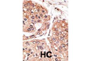 Formalin-fixed and paraffin-embedded human hepatocellular carcinoma tissue reacted with SMYD5 polyclonal antibody  , which was peroxidase-conjugated to the secondary antibody, followed by DAB staining. (SMYD5 Antikörper  (C-Term))