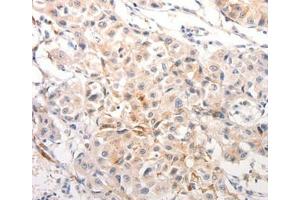Immunohistochemical analysis of paraffin-embedded Human breast cancer tissue using. (Keratin 6B Antikörper  (Internal Region))