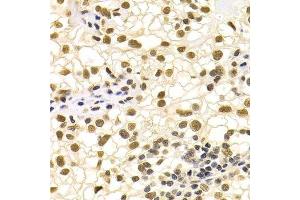 Immunohistochemistry of paraffin-embedded human kidney cancer using DDB1 Antibody. (DDB1 Antikörper)