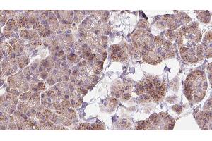 ABIN6273263 at 1/100 staining Human pancreas cancer tissue by IHC-P. (EIF2D Antikörper  (Internal Region))