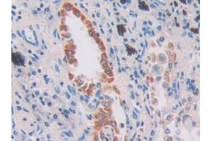 Detection of IFI16 in Human Lung cancer Tissue using Polyclonal Antibody to Interferon Gamma Inducible Protein 16 (IFI16) (IFI16 Antikörper  (AA 465-671))