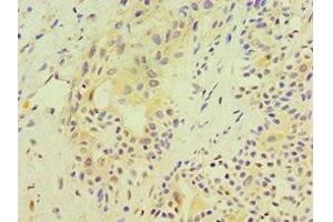 Immunohistochemistry of paraffin-embedded human breast cancer using ABIN7170540 at dilution of 1:100 (Spermidine Synthase Antikörper  (AA 1-302))
