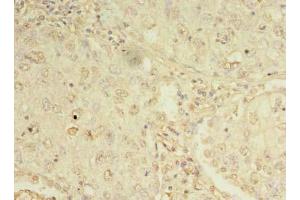 Immunohistochemistry of paraffin-embedded human lung cancer using ABIN7162276 at dilution of 1:100 (ORMDL1 Antikörper  (AA 48-100))
