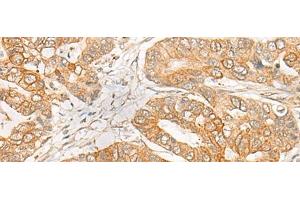 Immunohistochemistry of paraffin-embedded Human gastric cancer tissue using GNB1L Polyclonal Antibody at dilution of 1:35(x200)