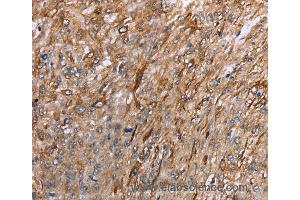 Immunohistochemistry of Human esophagus cancer using GRPR Polyclonal Antibody at dilution of 1:40