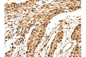 The image on the left is immunohistochemistry of paraffin-embedded Human esophagus cancer tissue using ABIN7192627(SPATA20 Antibody) at dilution 1/70, on the right is treated with synthetic peptide. (SPATA2 Antikörper)