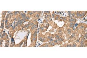 Immunohistochemistry of paraffin-embedded Human thyroid cancer tissue using BCHE Polyclonal Antibody at dilution of 1:40(x200) (Butyrylcholinesterase Antikörper)