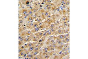 Formalin-fixed and paraffin-embedded human hepatocarcinoma with ADAMTS13 Antibody , which was peroxidase-conjugated to the secondary antibody, followed by DAB staining. (ADAMTS13 Antikörper  (AA 829-858))