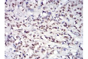 Immunohistochemical analysis of paraffin-embedded breast cancer tissues using JAK2 mouse mAb with DAB staining.