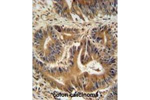 VPS52 antibody (C-term) immunohistochemistry analysis in formalin fixed and paraffin embedded human colon carcinoma followed by peroxidase conjugation of the secondary antibody and DAB staining.