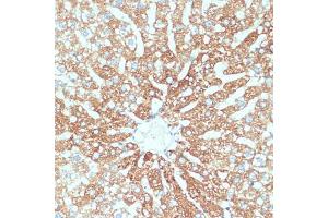 Immunohistochemistry of paraffin-embedded human colon carcinoma using SLC39 antibody (ABIN1682781, ABIN3017803, ABIN3017805 and ABIN6220263) at dilution of 1:100 (40x lens). (SLC39A4 Antikörper  (AA 23-327))